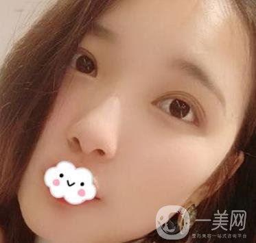 北京安貞醫(yī)院整容怎么樣？李斌斌修復(fù)雙眼皮怎么樣？內(nèi)含案例及價(jià)格表