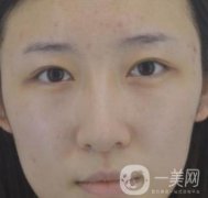 北京克萊美舍張冰潔雙眼皮評價(jià)怎么樣？案例及價(jià)格表一覽