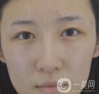 北京克萊美舍張冰潔雙眼皮評價(jià)怎么樣？案例及價(jià)格表一覽
