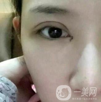 北京克萊美舍張冰潔雙眼皮評價(jià)怎么樣？案例及價(jià)格表一覽