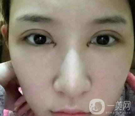 北京克萊美舍張冰潔雙眼皮評價(jià)怎么樣？案例及價(jià)格表一覽