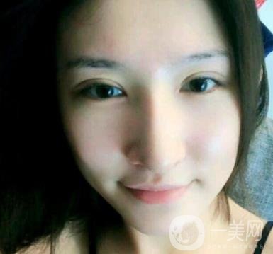 北京克萊美舍張冰潔雙眼皮評價(jià)怎么樣？案例及價(jià)格表一覽