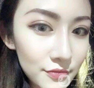 北京克萊美舍張冰潔雙眼皮評價(jià)怎么樣？案例及價(jià)格表一覽
