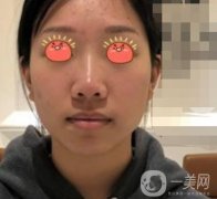廣東省人民醫(yī)院隆鼻案例及整形價(jià)格表分享