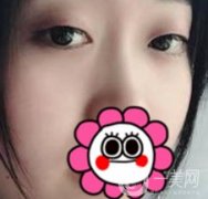 廣州紫馨醫(yī)療美容醫(yī)院割雙眼皮案例