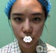 師俊莉醫(yī)生脂肪填充面部果及價格表一覽