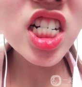 北大第三醫(yī)院整牙價(jià)格表，牙齒矯正果一覽