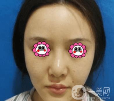 長沙中南大學(xué)*三醫(yī)院整形美容外科隆鼻多少錢？價格表及案例詳情