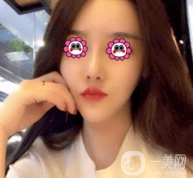 長沙中南大學(xué)*三醫(yī)院整形美容外科隆鼻多少錢？價格表及案例詳情