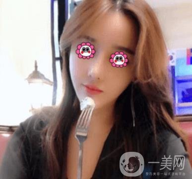 長沙中南大學(xué)*三醫(yī)院整形美容外科隆鼻多少錢？價格表及案例詳情