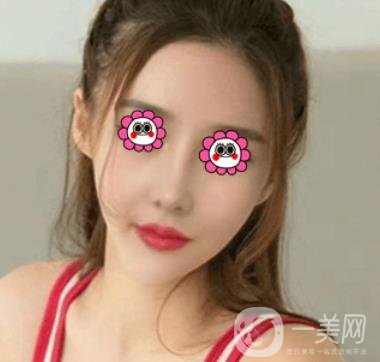 長沙中南大學(xué)*三醫(yī)院整形美容外科隆鼻多少錢？價格表及案例詳情