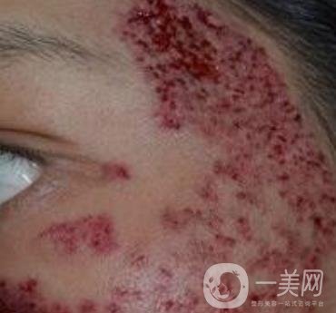 解放軍總醫(yī)院整形美容科*新價格表發(fā)布,附祛斑案例日記分享