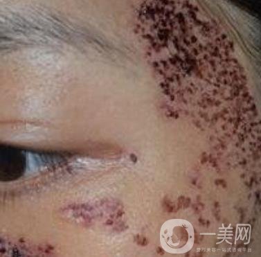 解放軍總醫(yī)院整形美容科*新價格表發(fā)布,附祛斑案例日記分享