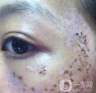 解放軍總醫(yī)院整形美容科*新價格表發(fā)布,附祛斑案例日記分享