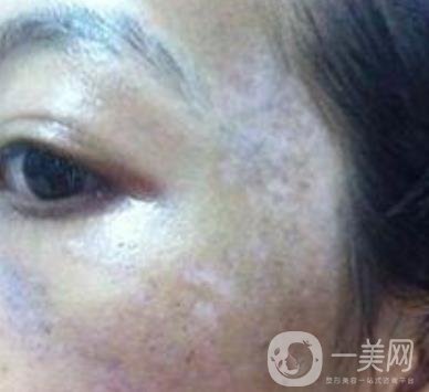 解放軍總醫(yī)院整形美容科*新價格表發(fā)布,附祛斑案例日記分享