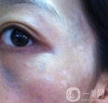 解放軍總醫(yī)院整形美容科*新價格表發(fā)布,附祛斑案例日記分享