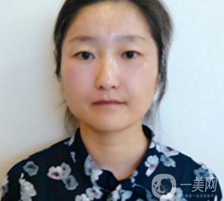 龍崗中心醫(yī)院整形外科價(jià)格表（收費(fèi)）,附去斑案例詳情