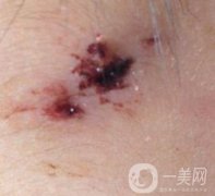 泰安市中心醫(yī)院美容整形科價(jià)格表,附祛疤案例果分享