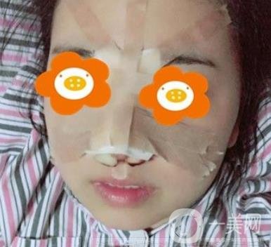 重慶西南醫(yī)院整形外科價格表2020_自體脂肪填充鼻部案例