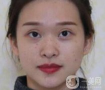 臨沂市人民醫(yī)院價格表2020_雙眼皮案例分享