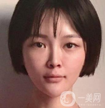 石家莊市醫(yī)院整形美容外科價格表2020，附雙眼皮實例