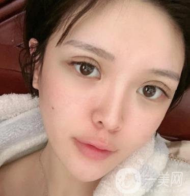 石家莊市醫(yī)院整形美容外科價格表2020，附雙眼皮實例