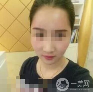 邢臺市人民醫(yī)院美容科陳譽(yù)華*案例_價(jià)格表明細(xì)