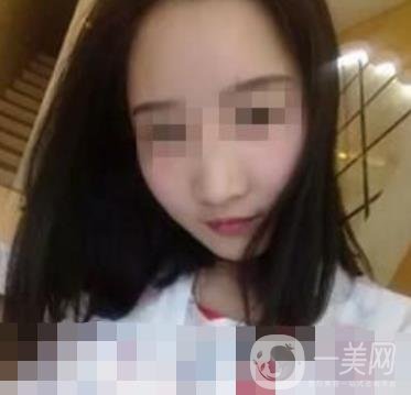 邢臺市人民醫(yī)院美容科陳譽(yù)華*案例_價(jià)格表明細(xì)