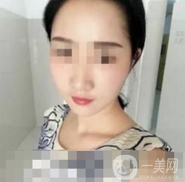 邢臺市人民醫(yī)院美容科陳譽(yù)華*案例_價(jià)格表明細(xì)