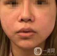 四川省人民醫(yī)院整形外科游曉波磨骨怎么樣?價(jià)格收費(fèi)明細(xì)表一覽