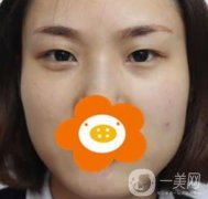 成都華西做雙眼皮前后果圖，附整形美容科價(jià)格收費(fèi)表一覽