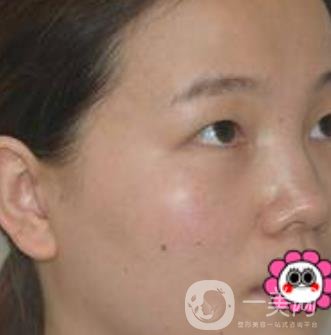 河南省人民醫(yī)院誰做雙眼皮好？附案例及2020整形價(jià)格表