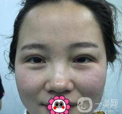 河南省人民醫(yī)院誰做雙眼皮好？附案例及2020整形價(jià)格表