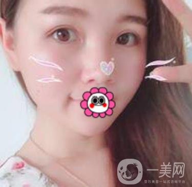 河南省人民醫(yī)院誰做雙眼皮好？附案例及2020整形價(jià)格表