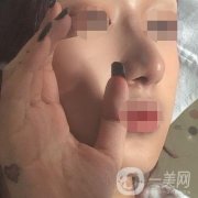 遼寧省人民醫(yī)院美容科怎么樣？附袁繼龍隆鼻案例