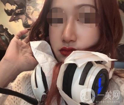 遼寧省人民醫(yī)院美容科怎么樣？附袁繼龍隆鼻案例