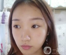 北大醫(yī)院美容價(jià)格表，附自體脂肪填充面部前后照