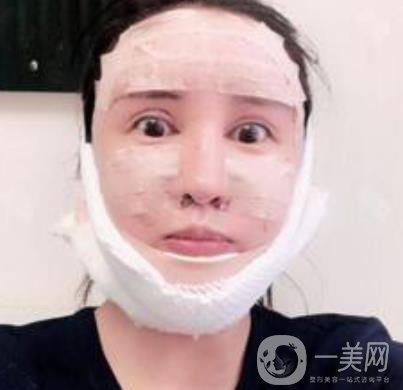 北大醫(yī)院美容價(jià)格表，附自體脂肪填充面部前后照