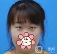 2020浙江省人民醫(yī)院整形價(jià)格表，附雙眼皮案例