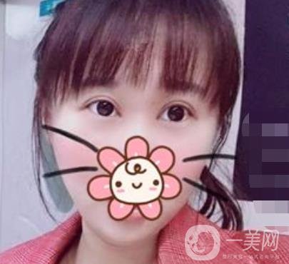 2020浙江省人民醫(yī)院整形價(jià)格表，附雙眼皮案例