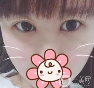 2020浙江省人民醫(yī)院整形價(jià)格表，附雙眼皮案例