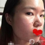 廣州荔灣區(qū)人民醫(yī)院*多少錢(qián)，美容科術(shù)后果展示