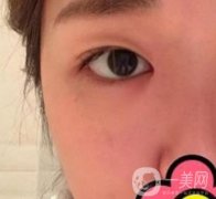 山大二院整形科2020價(jià)格表公布,附雙眼皮案例術(shù)后果圖