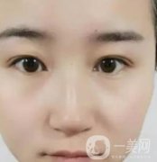 長(zhǎng)海醫(yī)院邢新做雙眼皮修復(fù)好嗎？?jī)r(jià)格表及案例詳情一覽