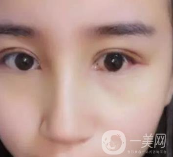 長海醫(yī)院邢新做雙眼皮修復好嗎？價格表及案例詳情一覽