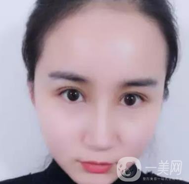 長海醫(yī)院邢新做雙眼皮修復好嗎？價格表及案例詳情一覽