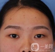 河北省人民醫(yī)院做雙眼皮咋樣?價(jià)格表一覽