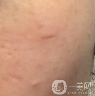 南通大學(xué)附屬醫(yī)院整形科價格表，附激光去疤案例
