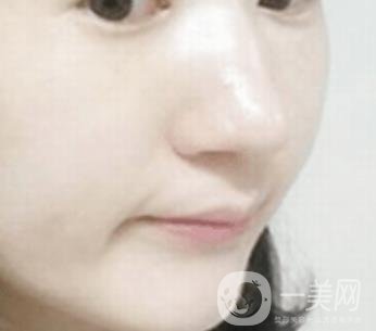 南通大學(xué)附屬醫(yī)院整形科價格表，附激光去疤案例
