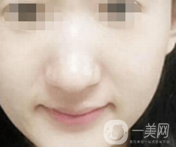 南通大學(xué)附屬醫(yī)院整形科價格表，附激光去疤案例